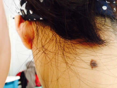 嘴上一个黑痣,嘴上有一颗很大的痣去掉后的图