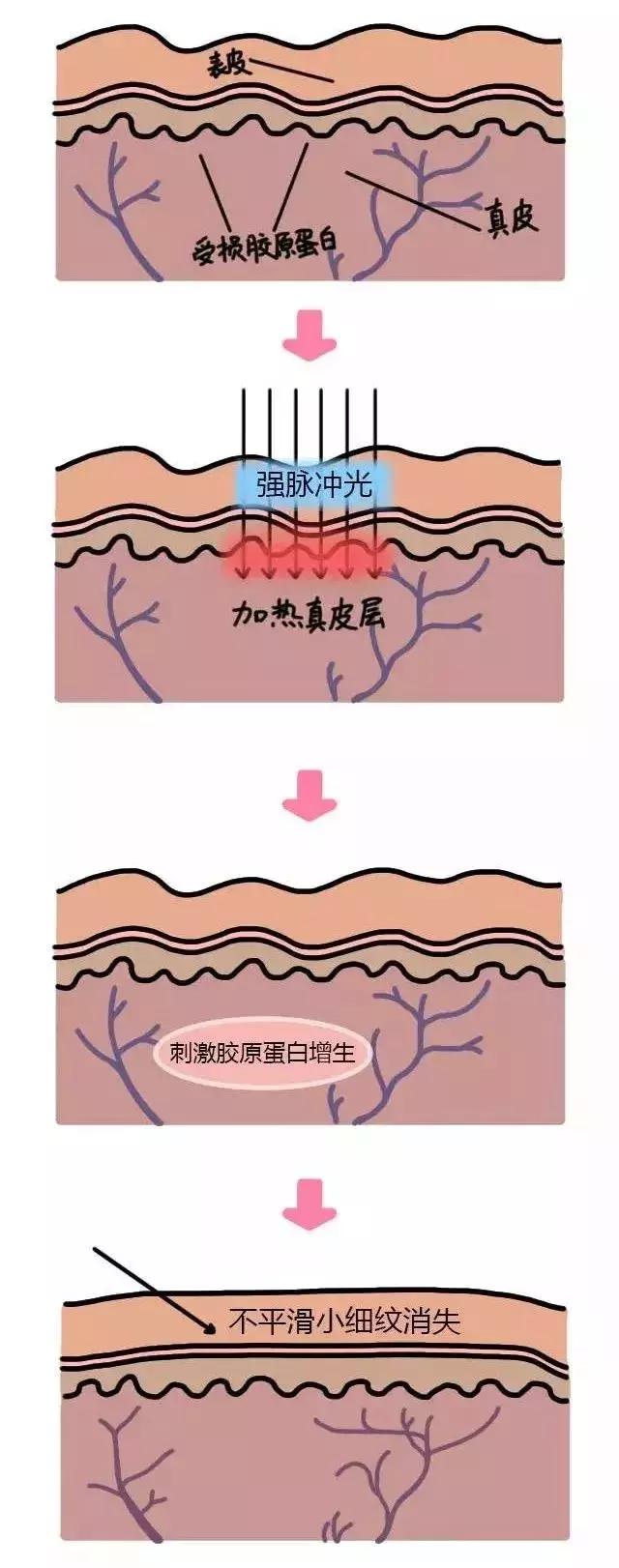 光子嫩肤帮你逆袭,光子嫩肤多种效果操作视频
