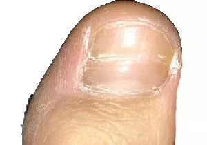 怎么从指甲上看健康图解,从指甲看疾病的图片说明