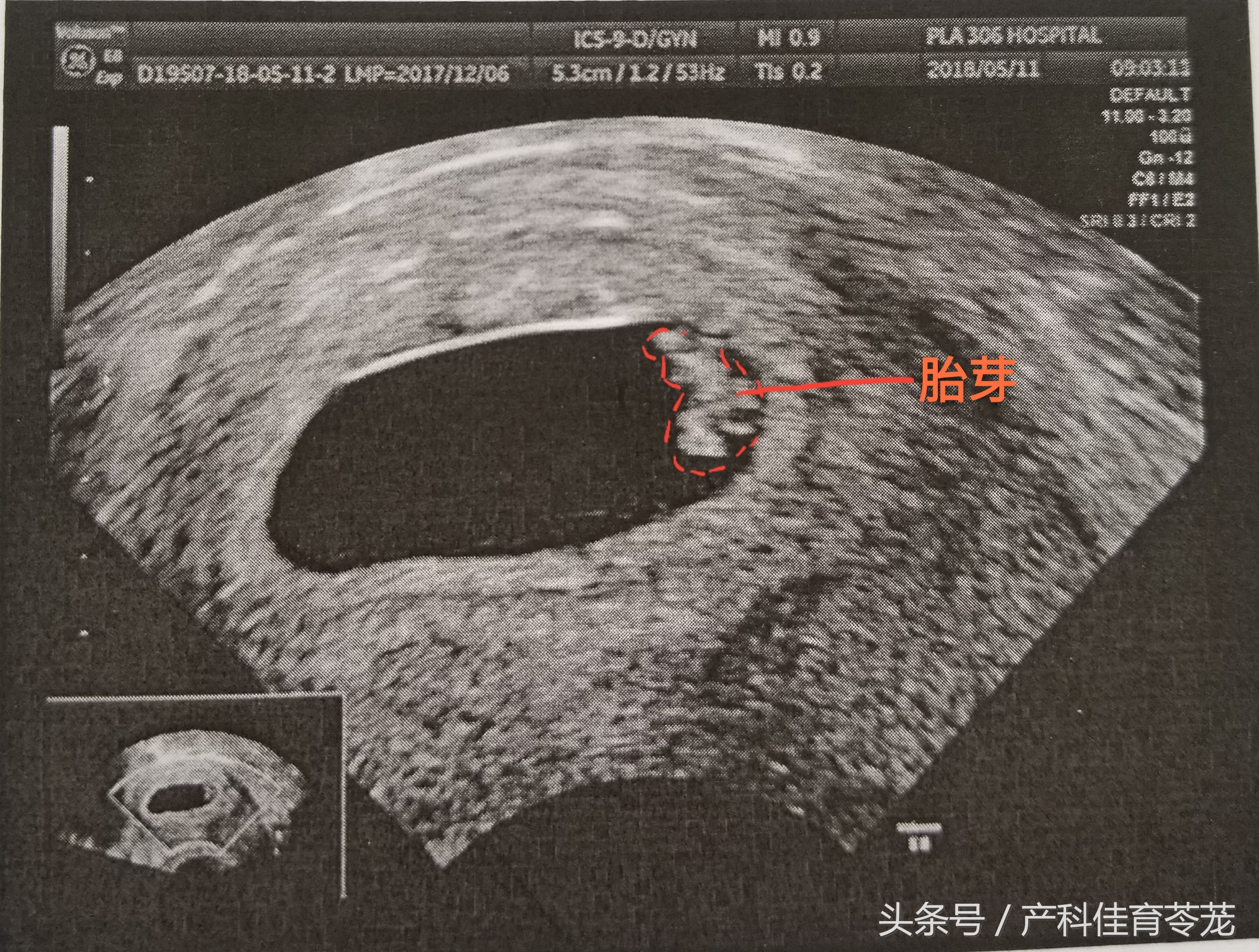 如何看懂乳腺超声检查报告,怎么能让临床医生看懂超声报告