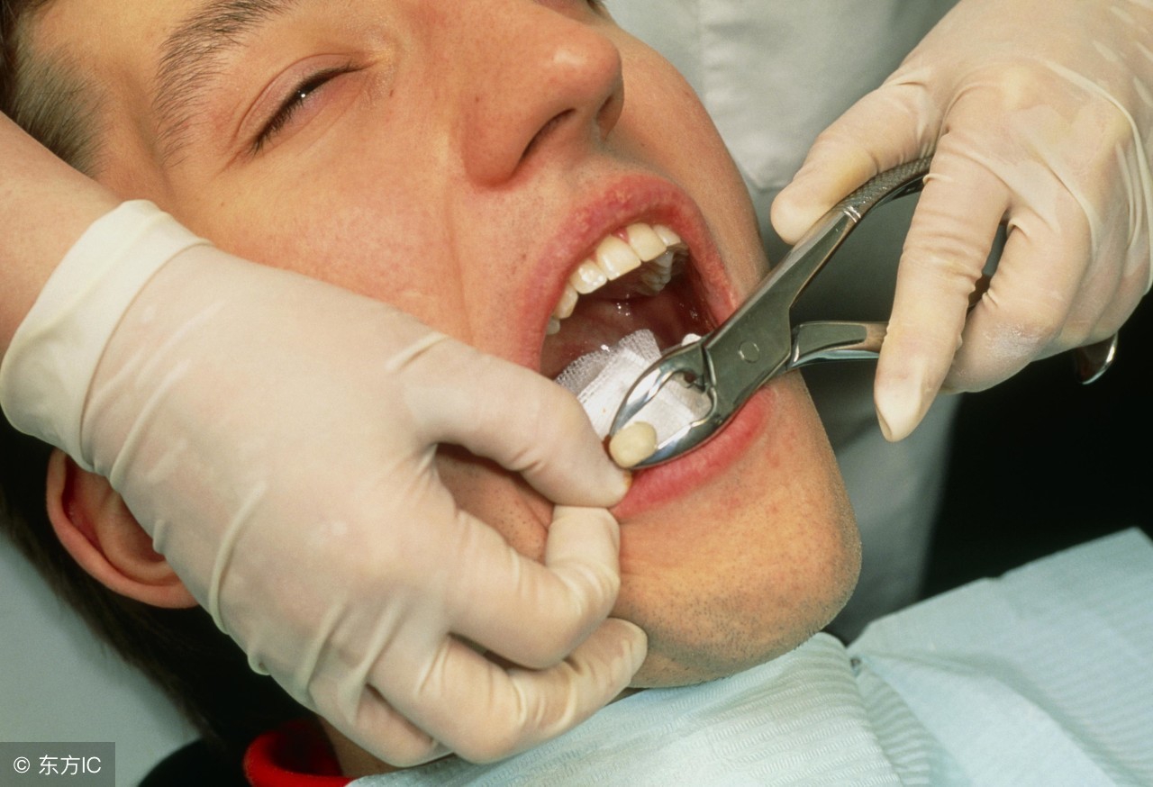 拔智齿后注意事项与饮食禁忌,拔智齿后注意事项几天可刷牙