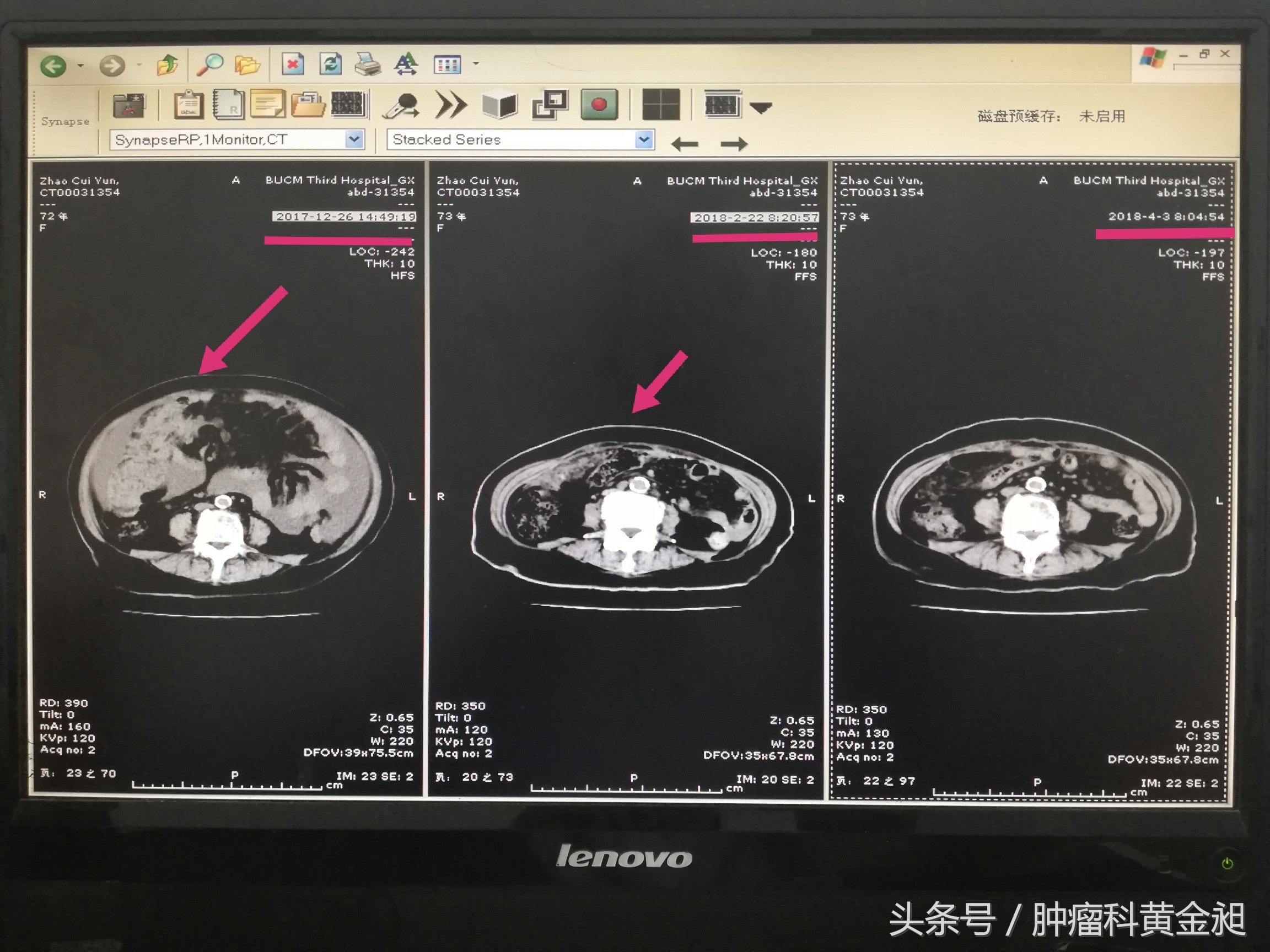 中医治疗卵巢癌晚期,卵巢癌中西医结合治疗能痊愈吗