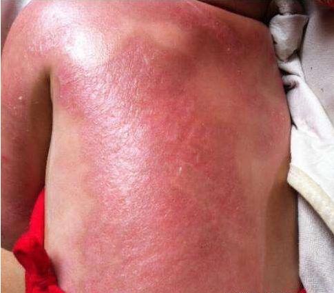 宝宝二度烫伤后期怎么好得快,宝宝二级烫伤多久可以恢复到正常