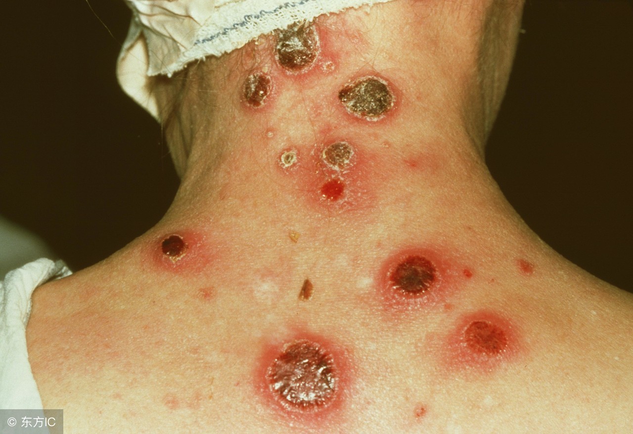 孕初期孕检检查出梅毒怎么办,孕妇怀孕发现有梅毒怎么治疗