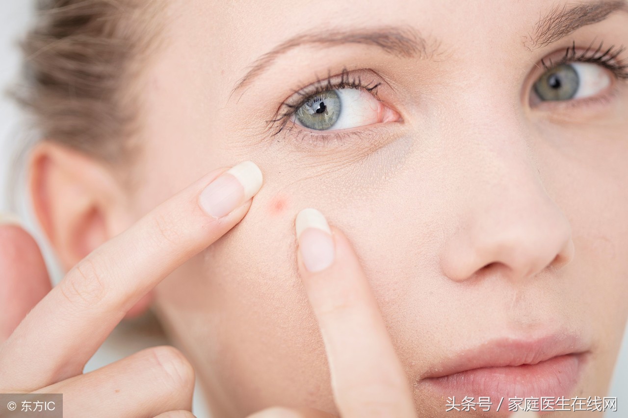 长痘痘如何调理试试这几个方法吧,皮肤长痘痘怎么调理15岁