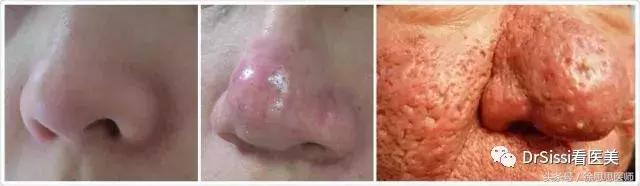 专业去除各种斑痘,专治脸上各种斑各种痘