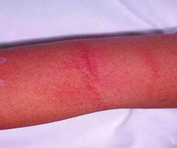 夏季猩红热高发家有娃娃要当心,为什么猩红热高发于儿童