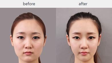 咬肌大显脸大咬肌大怎么瘦脸,瘦咬肌方法很重要方脸秒变小v脸