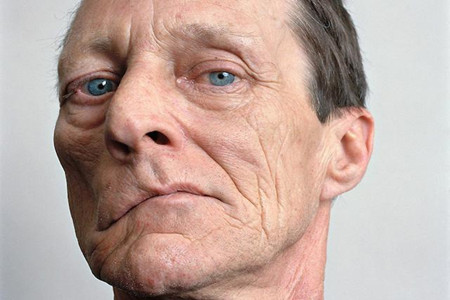 缓解面肌痉挛的锻炼操,面肌痉挛物理治疗方法都有什么呢