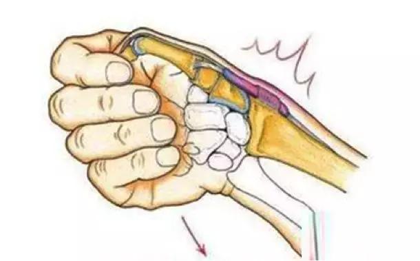 产后手腕疼妈妈要当心腱鞘炎,产后手腕疼当心抱孩子抱出腱鞘炎