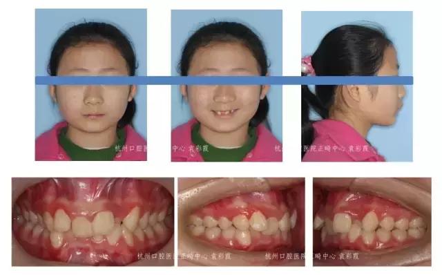 原来，上牙盖住下牙太多，也对牙齿有伤害！该怎么矫正？