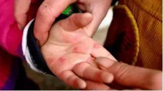 口腔疱疹发热怎么办,小孩发热口腔有疱疹