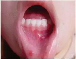 口腔疱疹发热怎么办,小孩发热口腔有疱疹