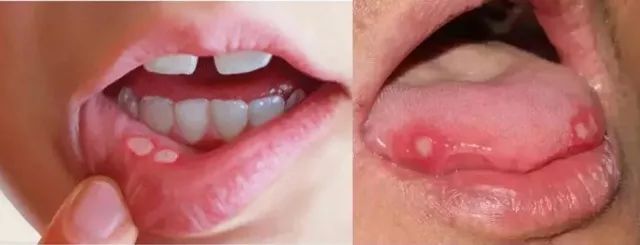 三十秒止痛口腔溃疡,5秒钟治口腔溃疡的药
