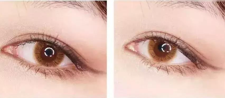 美瞳戴久后果,美瞳新手佩戴日常怎么护理