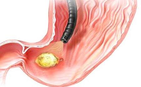 宝宝消化道出血怎么诊断,婴儿突然吐血是什么原因