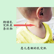 小儿斜颈推拿治疗费用能不能报销,小儿斜颈推拿治疗方法