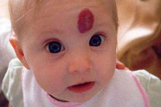 新生儿黑色胎记是什么原因造成的,新生儿手上有红色胎记是什么原因