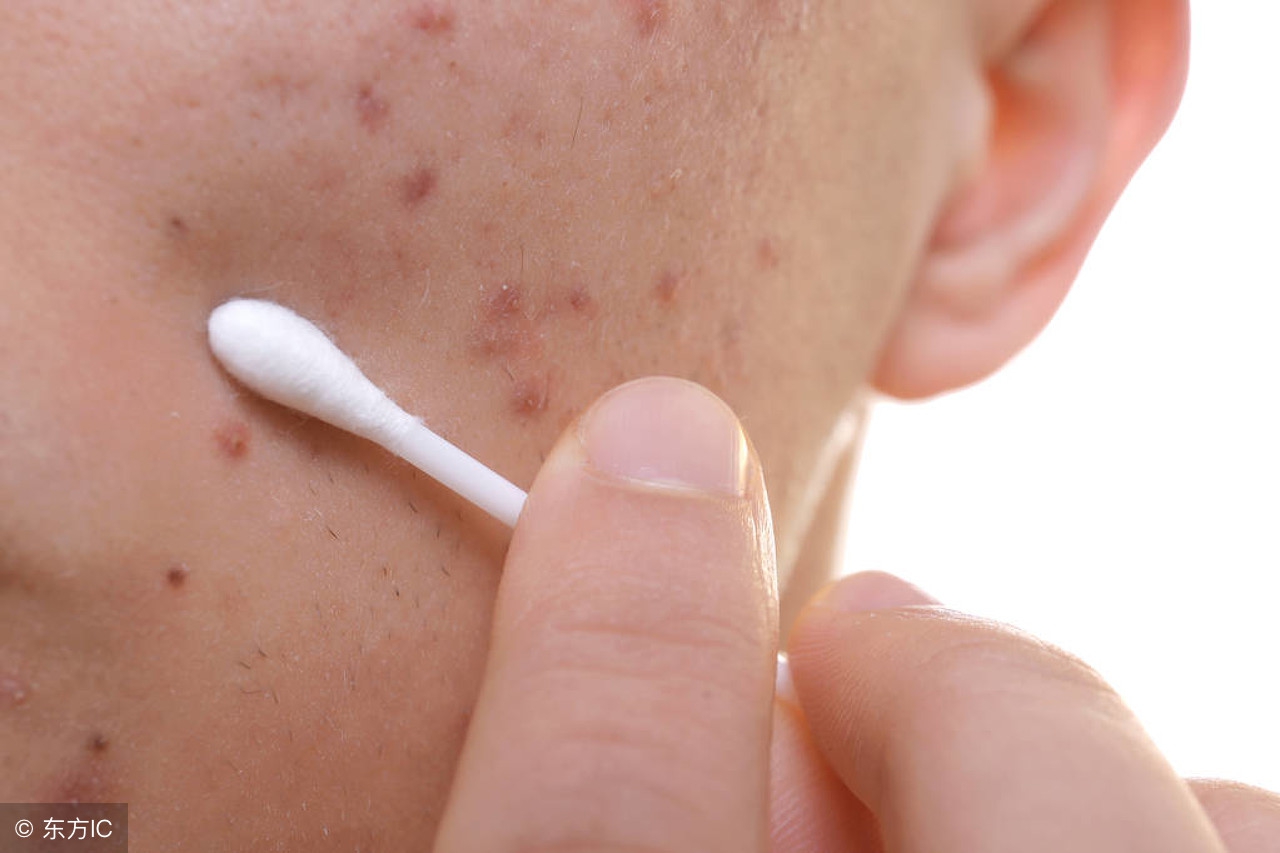 怎样才能消除痘,怎样才能彻底消除痘