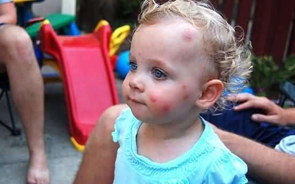 蚊虫叮咬怎么消肿止痒最快最有效,蚊虫叮咬教您几招止痒简单又快速