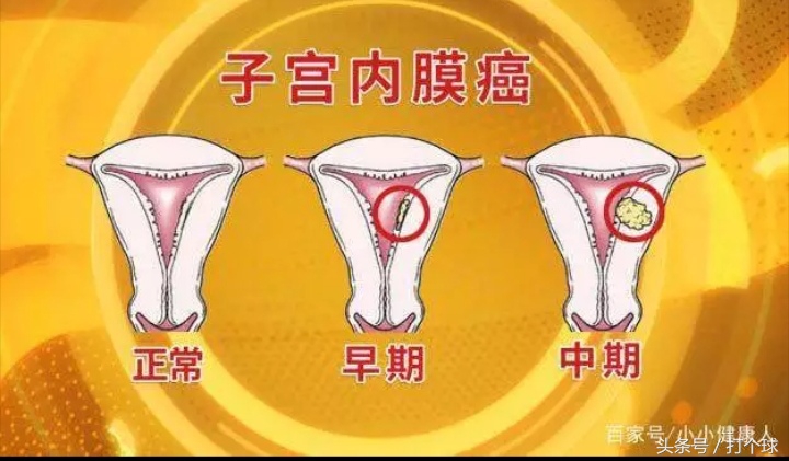 女大学生刚毕业不久就被查出子宫内膜癌，原因竟来自她的黑人男友