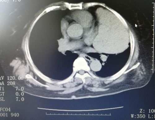 纵隔肿瘤侵犯食管是良性的吗,纵隔恶性肿瘤没转移能治愈吗