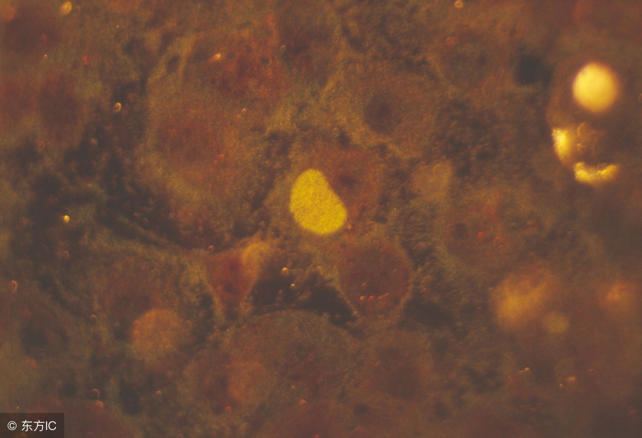 宫颈炎应该怎么合理治疗,宫颈炎都有哪些症状该怎么办