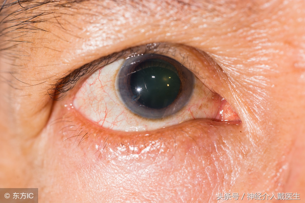 脑外伤瞳孔一大一小怎么回事,脑血管意外双侧瞳孔消失