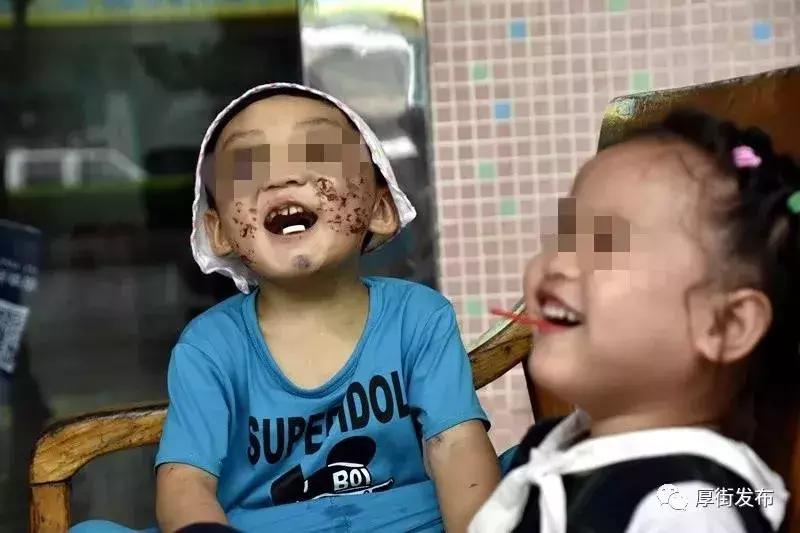 4岁男孩被打满身伤痕,小孩被父母暴打脸打肿