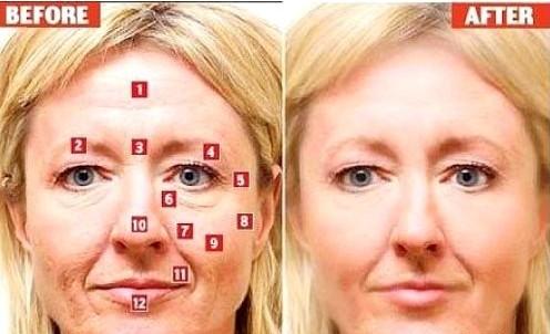 拉皮除皱手术真的有效吗,微创除皱手术与大拉皮除皱手术