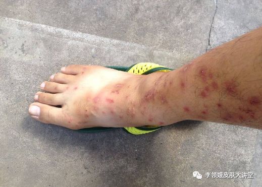 「杏林微科普」真假“香港脚”