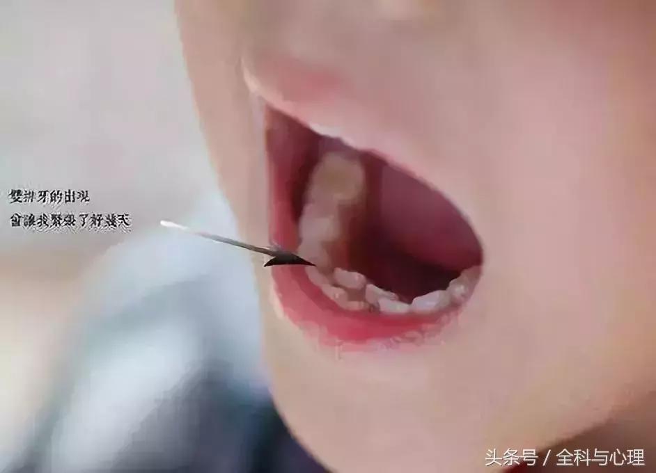 孩子帮妈妈功不可没,小孩双排牙最佳解决方法