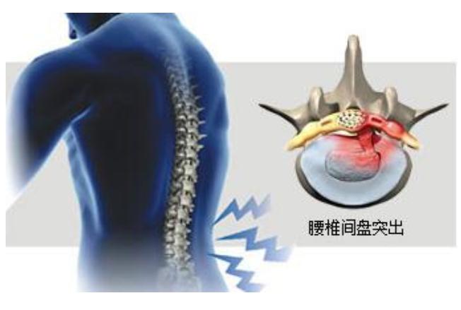 得了腰椎间盘突出腰腿疼痛难忍？三招缓解疼痛快收好
