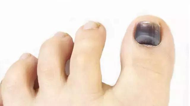 跑步大脚趾起水泡是怎么回事,跑步脚上出现黑趾甲该怎么处理