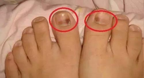 跑步大脚趾起水泡是怎么回事,跑步脚上出现黑趾甲该怎么处理