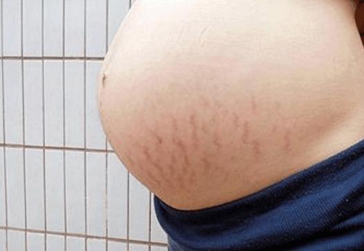 妊娠线和肤色有关系吗,妊娠线都是对称的吗