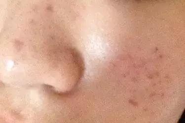 祛痘印干货分享,最全祛痘攻略快速祛痘不留痕