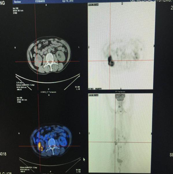 找不到原发病灶是好事吗,petct也做了还没找到原发灶怎么办