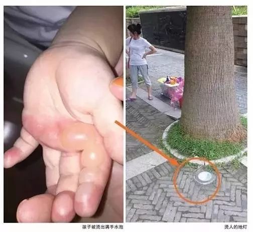 儿童玩耍金属滑梯被烫伤怎么处理,孩子玩滑滑梯屁股被烫伤