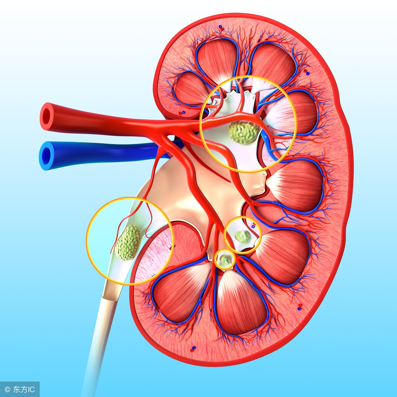 输尿管结石激光治疗有副作用吗,输尿管下段结石能用激光治疗吗