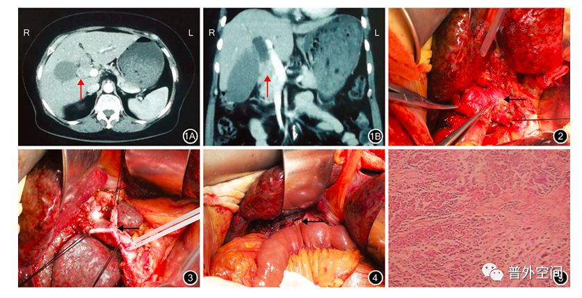 胆管占位怎么治疗,肝外胆管近中段实性占位