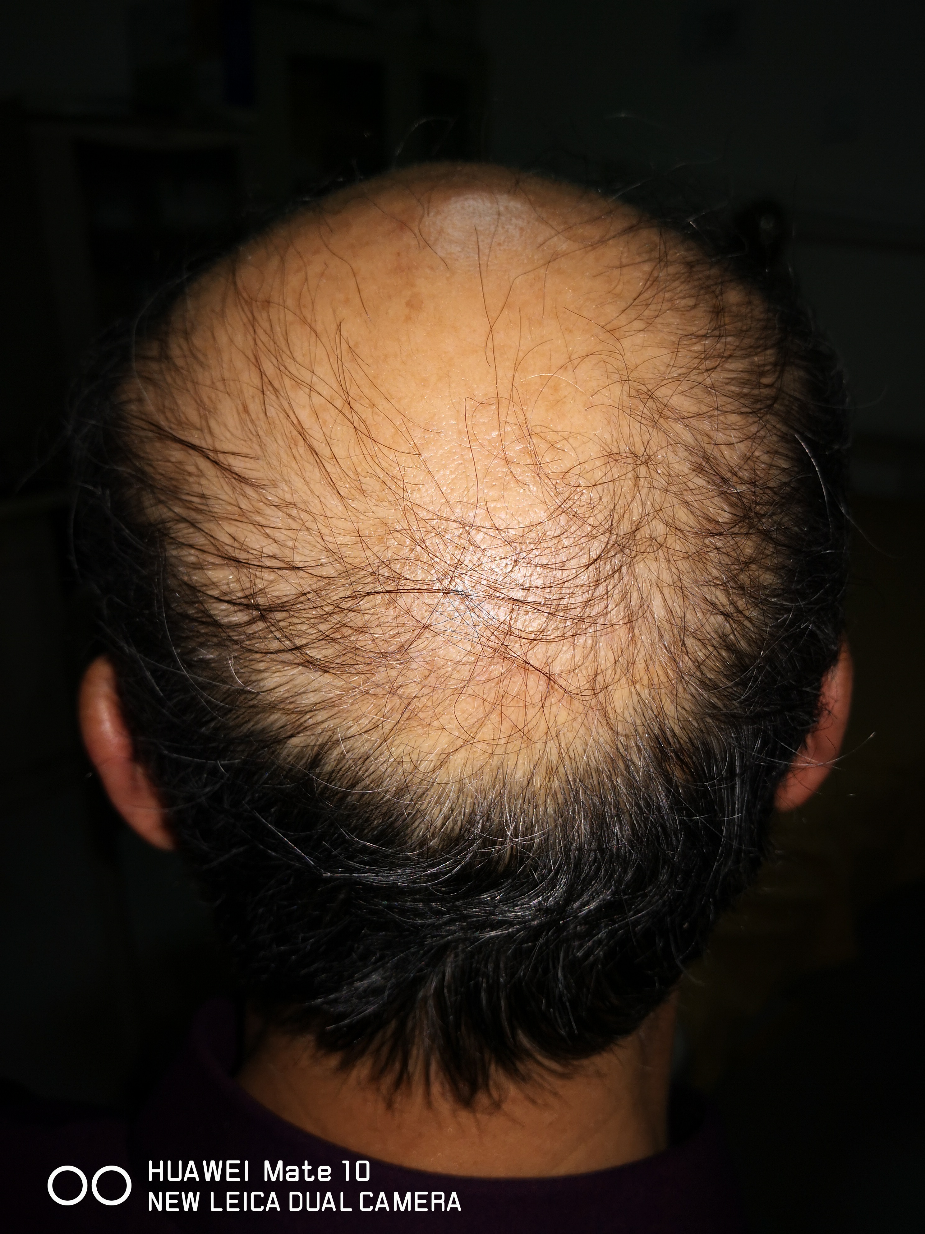 股骨头坏死二期置换好吗,遗传型脱发白发