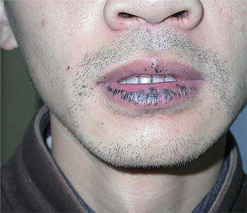 嘴唇上有黑斑是有癌症了吗,嘴唇有黑斑是肠道有病吗