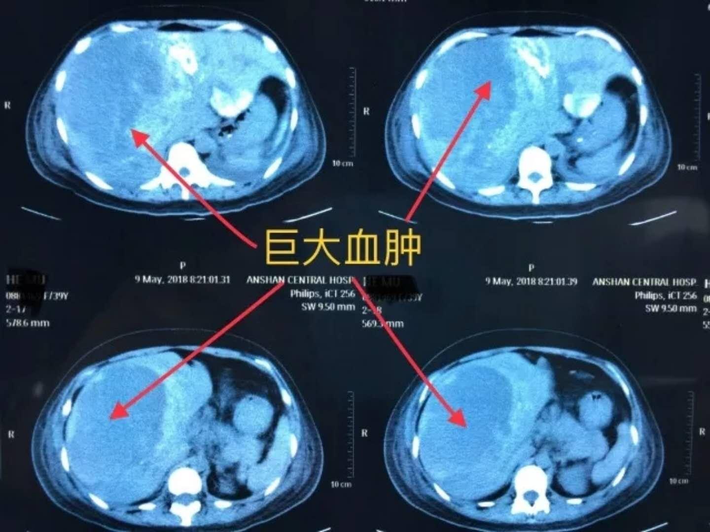 避孕药这3个副作用吃之前要知晓,避孕药的不良反应容易发生吗