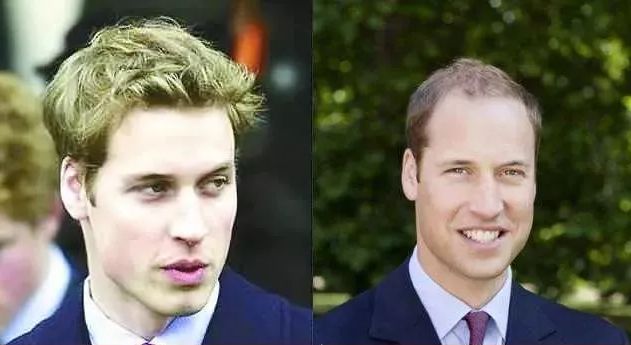 脱发、发际线高、地中海的克星！用它，1个月头发不掉了，不痒了，半年变浓密