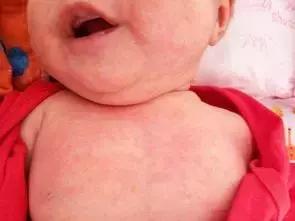 孕期怎么防止胎儿长湿疹,孕期吃什么可以预防胎儿湿疹