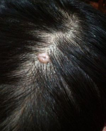 头皮瘙痒怎么治疗最有效,头皮脸部瘙痒是怎么回事