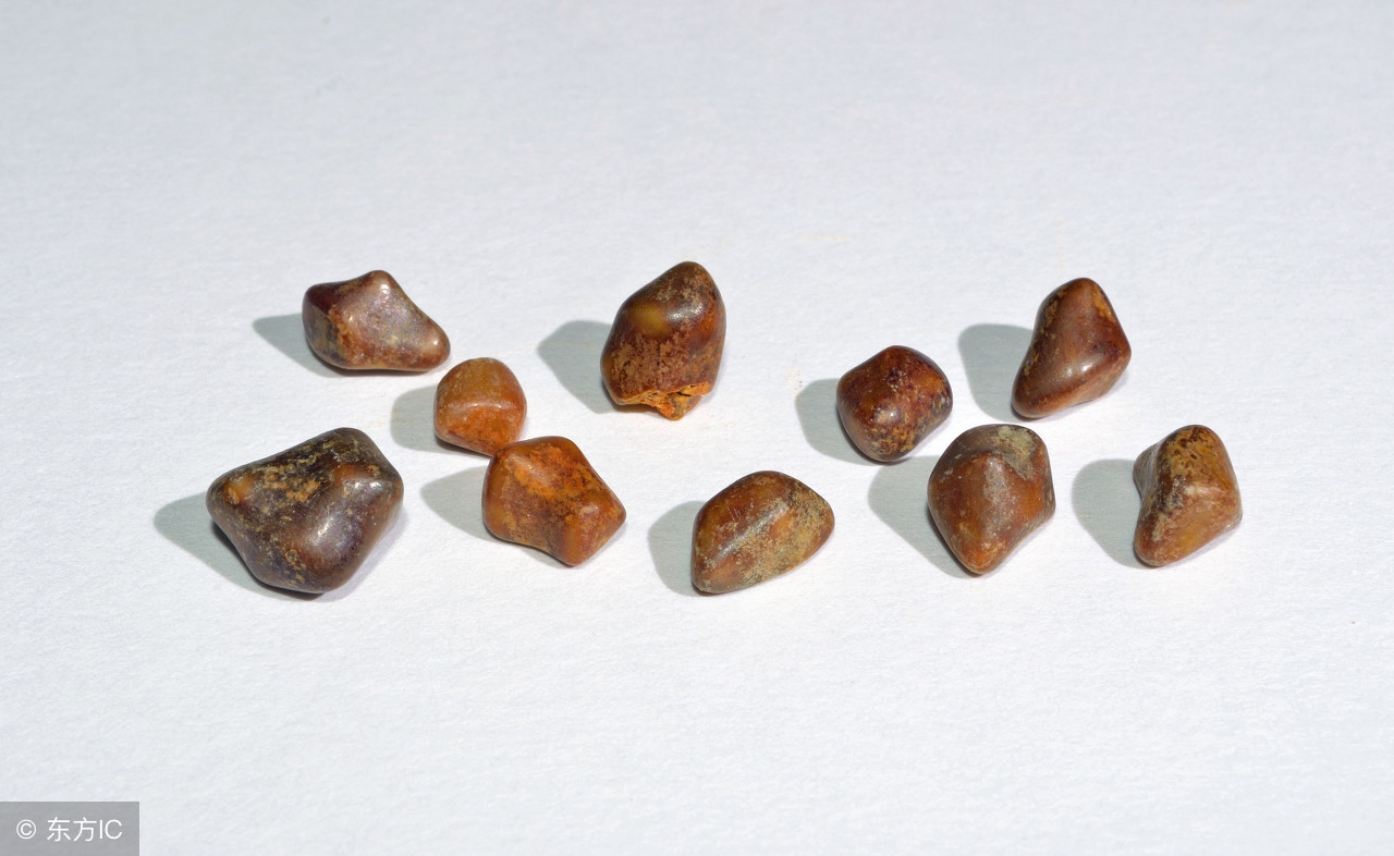 细说肾结石的病因都有哪些,肾结石传言全集