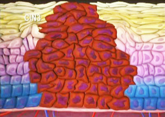 宫颈癌前病变不用怕，及时发现早治疗