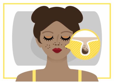 皮秒和超皮秒哪个祛斑效果好些,皮秒祛斑视频疼吗